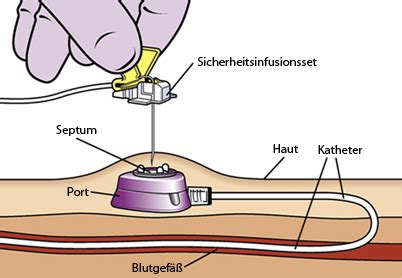 port nicht rückläufig|Intravenöse Langzeitsysteme: Richtiger Umgang mit dem Port